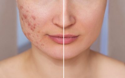 Tratamiento de cicatrices de acné con láser para una piel uniforme y renovada