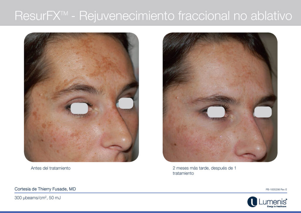 Tratamiento antimanchas con laser ipl