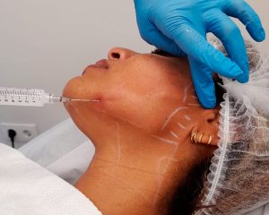 bioestimuladores de colágeno