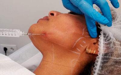 Bioestimuladores de colágeno: qué son, cómo funcionan y para quién son adecuados