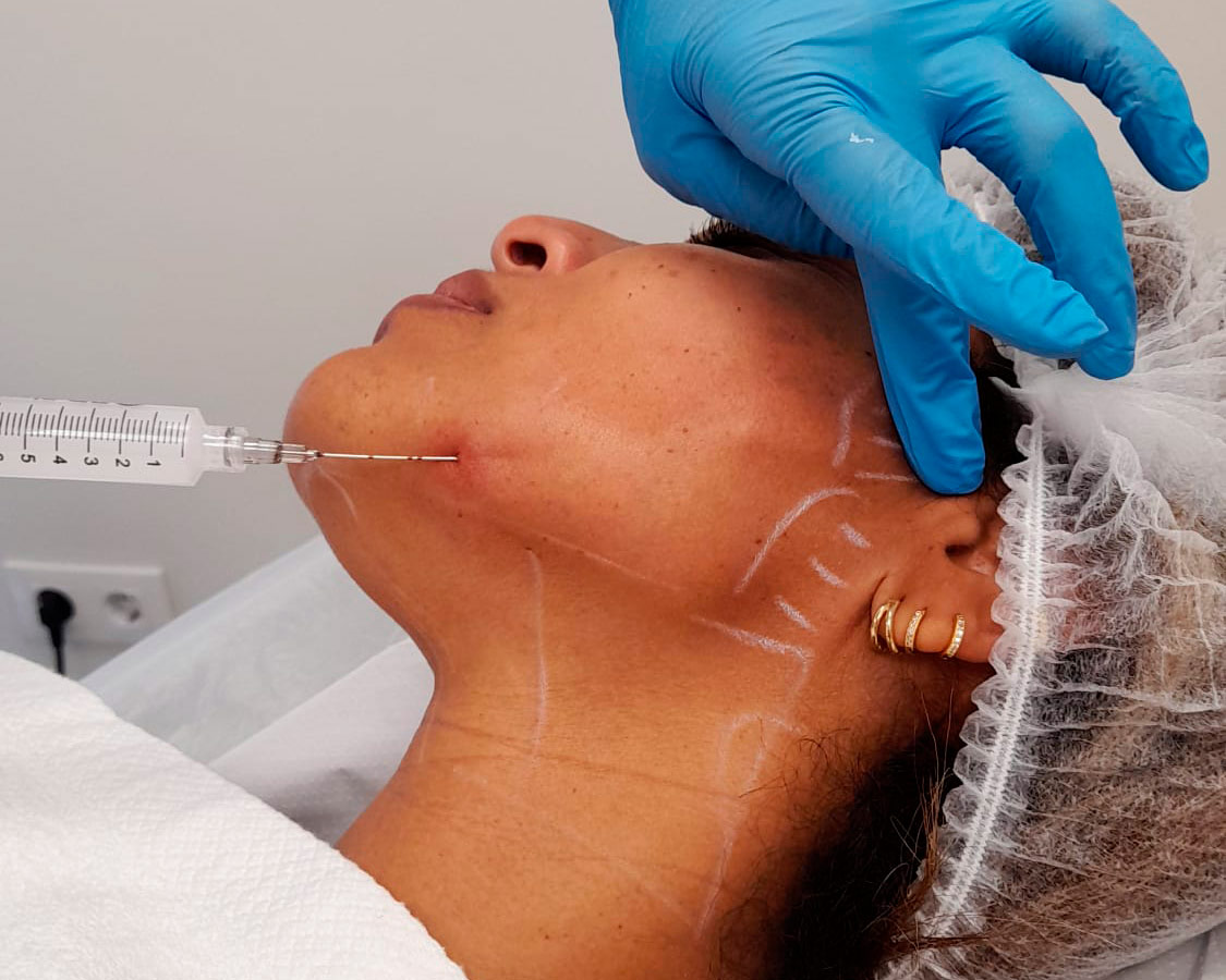 Bioestimuladores de colágeno: qué son, cómo funcionan y para quién son adecuados