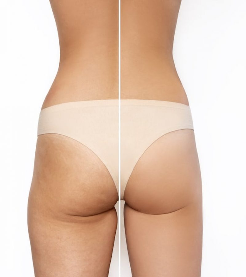 Celulitis antes y después tratamiento Dra Elmira