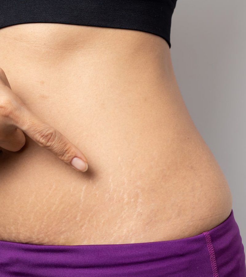 Tratamiento Corporal de Estrías Dra Elmira