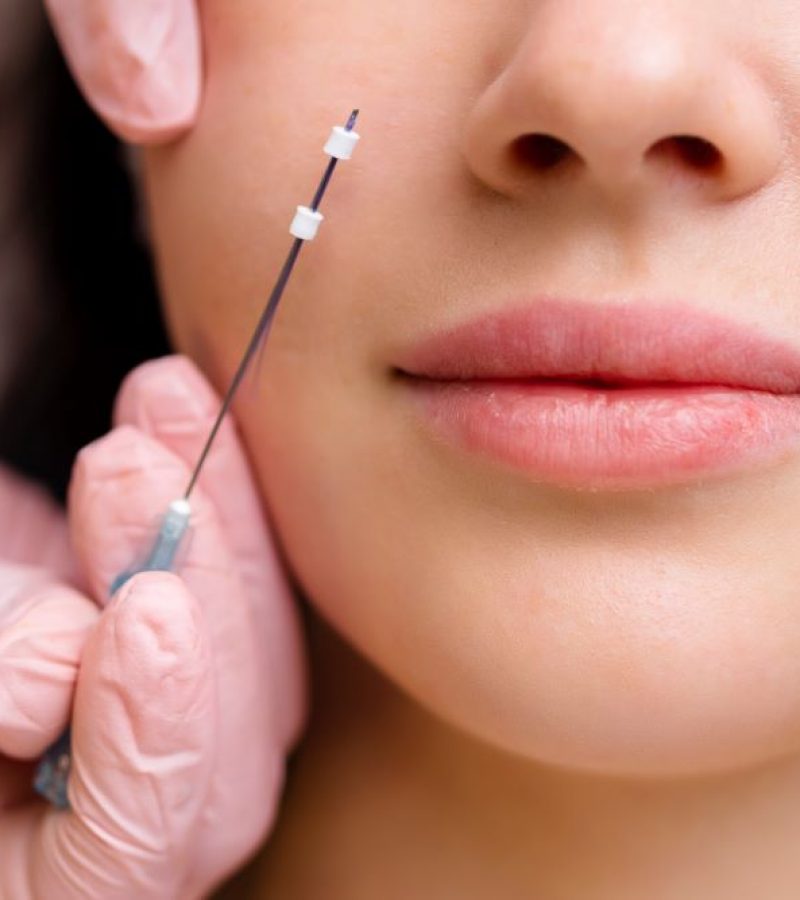 Hilos tensores tratamiento clinica dra Elmira