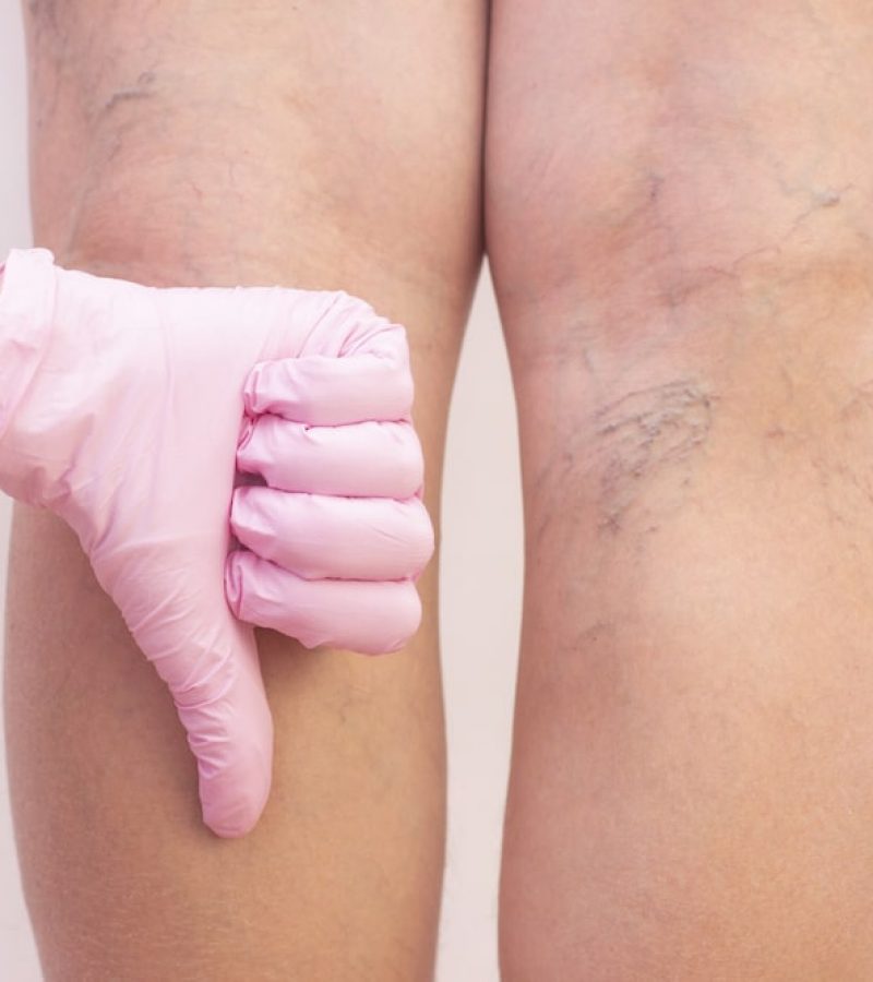 Tratamiento Corporal de Varices Dra Elmira