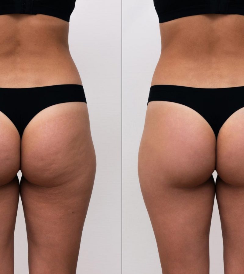 Tratamiento Corporal para Celulitis Dra Elmira